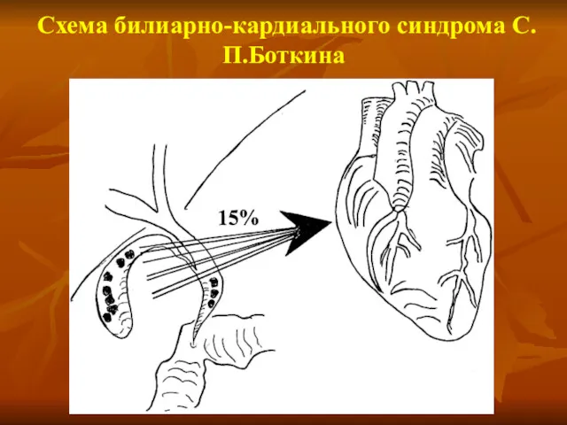 Схема билиарно-кардиального синдрома С.П.Боткина