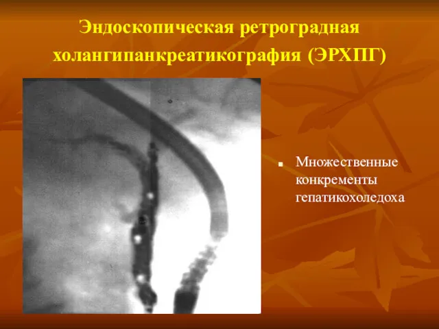 Эндоскопическая ретроградная холангипанкреатикография (ЭРХПГ) Множественные конкременты гепатикохоледоха