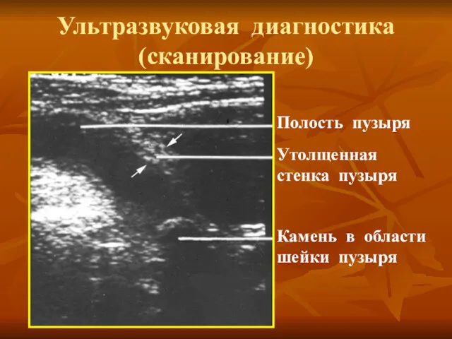 Ультразвуковая диагностика (сканирование) Полость пузыря Утолщенная стенка пузыря Камень в области шейки пузыря