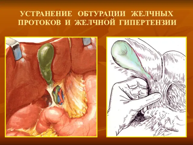 УСТРАНЕНИЕ ОБТУРАЦИИ ЖЕЛЧНЫХ ПРОТОКОВ И ЖЕЛЧНОЙ ГИПЕРТЕНЗИИ