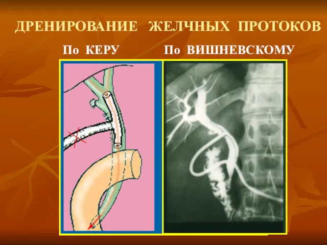 ДРЕНИРОВАНИЕ ЖЕЛЧНЫХ ПРОТОКОВ По КЕРУ По ВИШНЕВСКОМУ