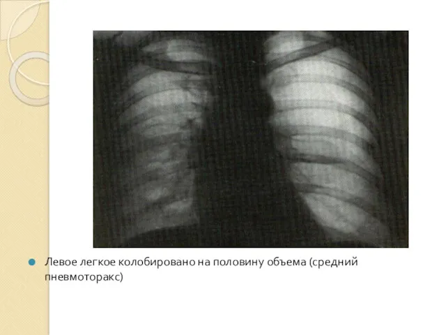 Левое легкое колобировано на половину объема (средний пневмоторакс)