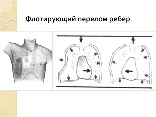 Флотирующий перелом ребер