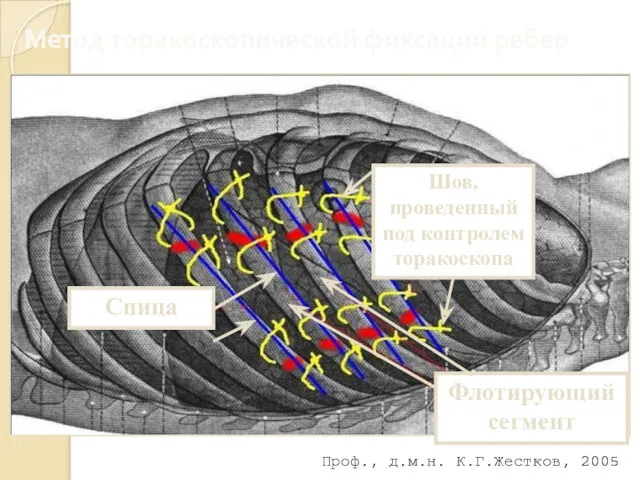 Метод торакоскопической фиксации ребер Шов, проведенный под контролем торакоскопа Флотирующий сегмент Спица Проф., д.м.н. К.Г.Жестков, 2005
