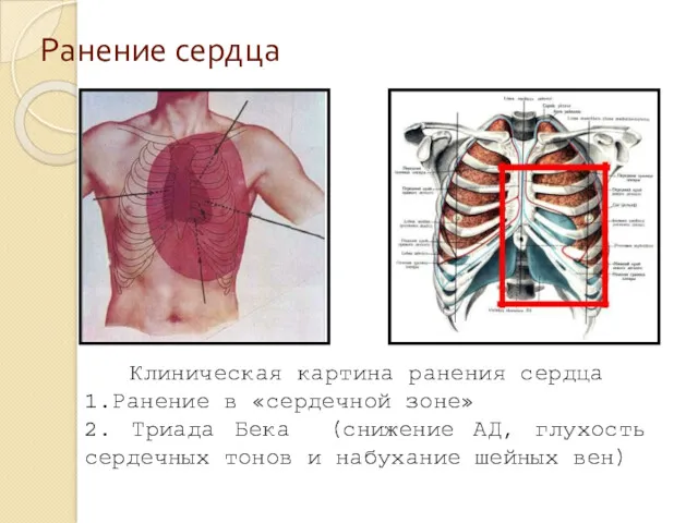 Ранение сердца Клиническая картина ранения сердца 1.Ранение в «сердечной зоне»