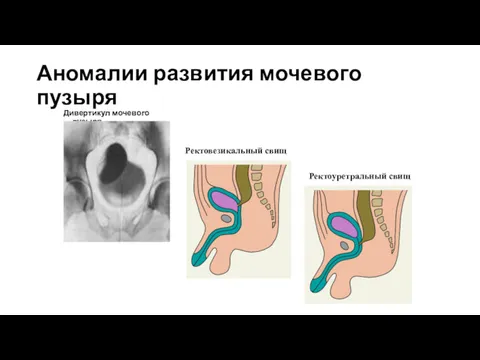 Аномалии развития мочевого пузыря Дивертикул мочевого пузыря Ректоуретральный свищ Ректовезикальный свищ