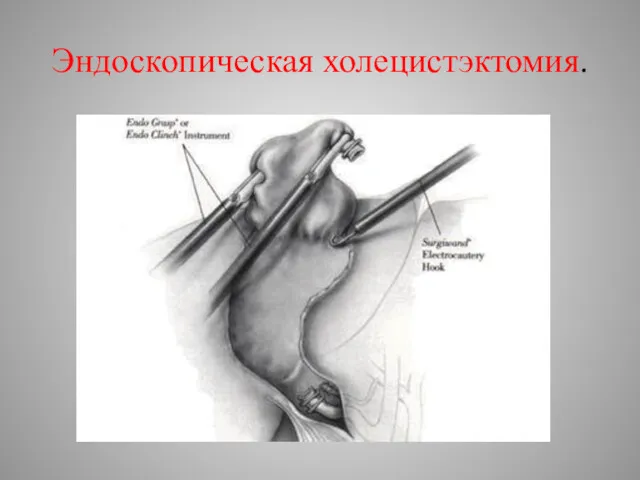 Эндоскопическая холецистэктомия.