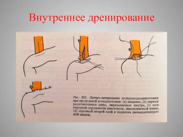 Внутреннее дренирование