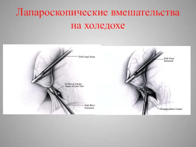 Лапароскопические вмешательства на холедохе