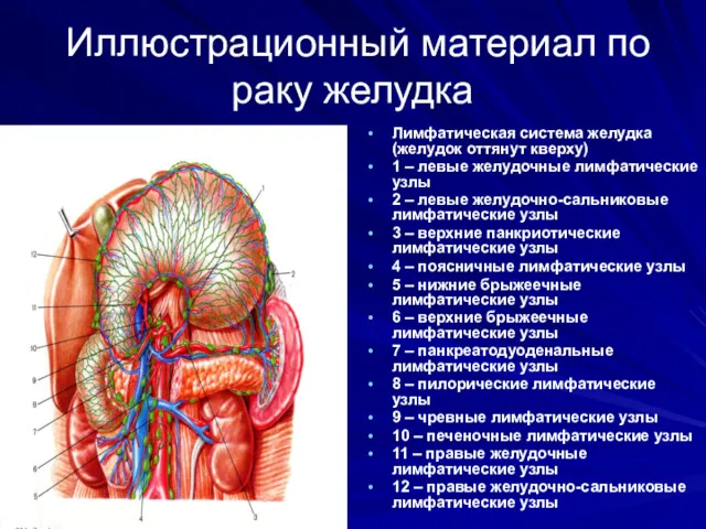 Иллюстрационный материал по раку желудка Лимфатическая система желудка (желудок оттянут кверху) 1 –