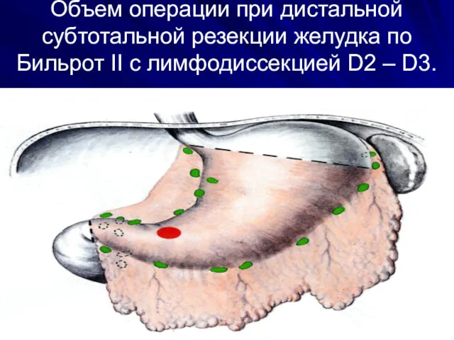 Объем операции при дистальной субтотальной резекции желудка по Бильрот II с лимфодиссекцией D2 – D3.