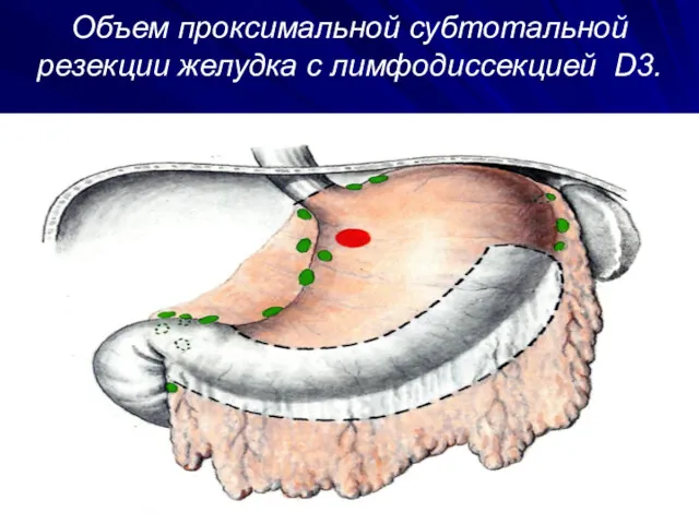 Объем проксимальной субтотальной резекции желудка с лимфодиссекцией D3.