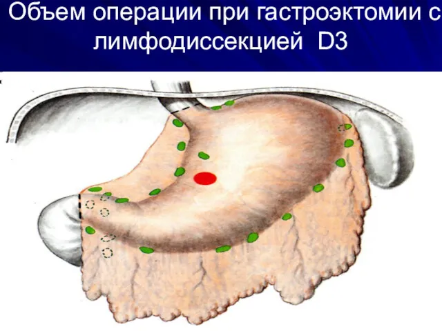 Объем операции при гастроэктомии c лимфодиссекцией D3