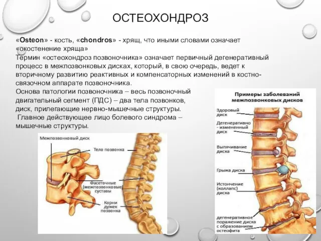 ОСТЕОХОНДРОЗ «Osteon» - кость, «chondros» - хрящ, что иными словами