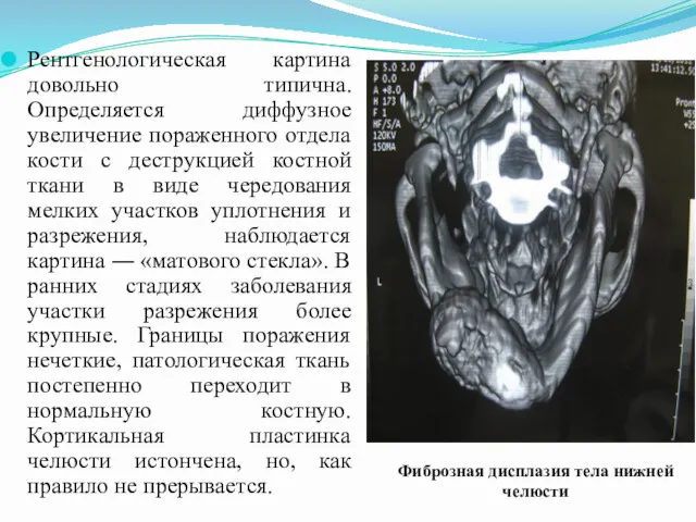 Рентгенологическая картина довольно типична. Определяется диффузное увеличение пораженного отдела кости с деструкцией костной