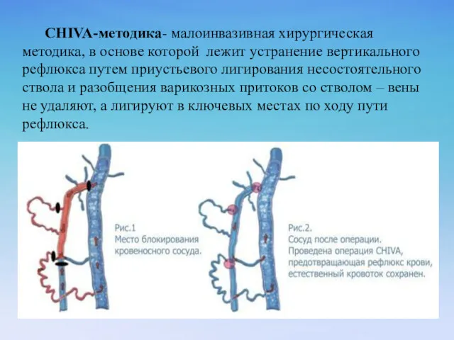 CHIVA-методика- малоинвазивная хирургическая методика, в основе которой лежит устранение вертикального рефлюкса путем приустьевого