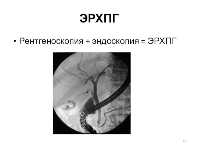 ЭРХПГ Рентгеноскопия + эндоскопия = ЭРХПГ
