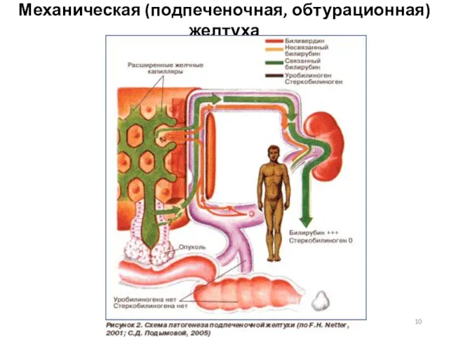 Механическая (подпеченочная, обтурационная) желтуха