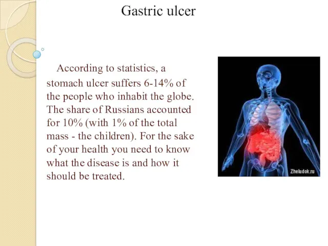 According to statistics, a stomach ulcer suffers 6-14% of the