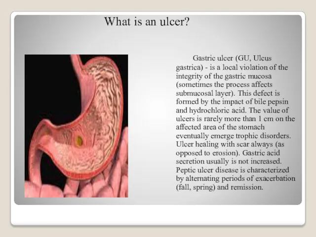 Gastric ulcer (GU, Ulcus gastrica) - is a local violation