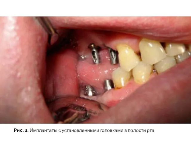 Рис. 3. Имплантаты с установленными головками в полости рта