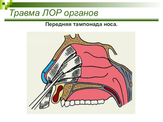 Травма ЛОР органов Передняя тампонада носа.