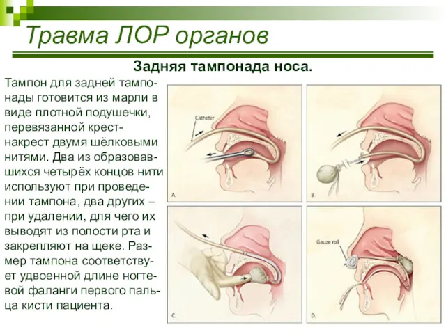 Травма ЛОР органов Задняя тампонада носа. Тампон для задней тампо-