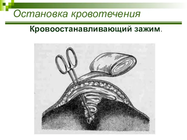 Остановка кровотечения Кровоостанавливающий зажим.