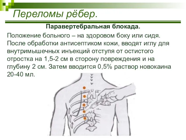 Паравертебральная блокада. Положение больного – на здоровом боку или сидя.