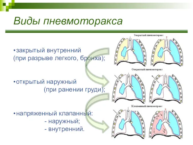 Виды пневмоторакса закрытый внутренний (при разрыве легкого, бронха); открытый наружный