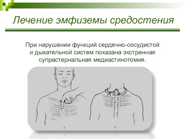 Лечение эмфиземы средостения При нарушении функций сердечно-сосудистой и дыхательной систем показана экстренная супрастернальная медиастинотомия.