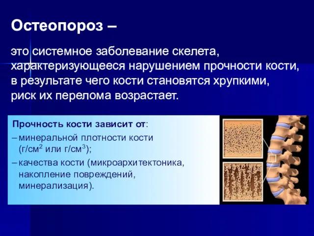 Остеопороз – это системное заболевание скелета, характеризующееся нарушением прочности кости,