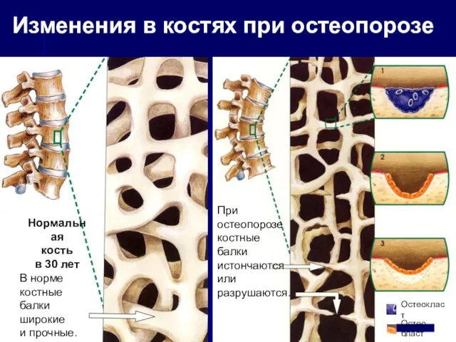 Нормальная кость в 30 лет Остеокласт Остеобласт Изменения в костях при остеопорозе При