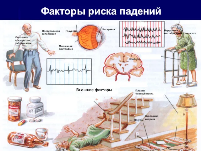 Факторы риска падений Глаукома Мышечная дистрофия Катаракта Неустойчивость Слабость ЭЭГ Нарушения вестибулярного аппарата