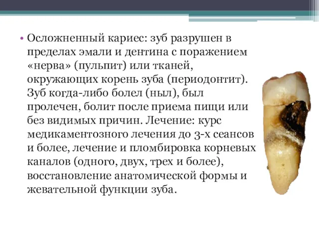 Осложненный кариес: зуб разрушен в пределах эмали и дентина с поражением «нерва» (пульпит)