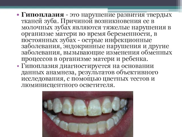 Гипоплазия - это нарушение развития твердых тканей зуба. Причиной возникновения ее в молочных