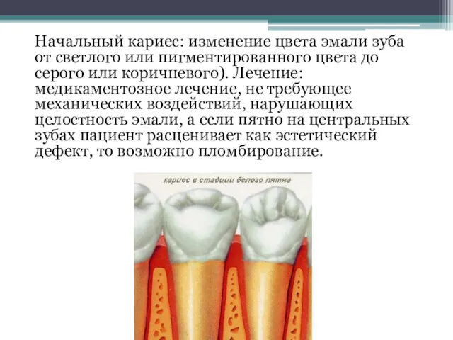 Начальный кариес: изменение цвета эмали зуба от светлого или пигментированного