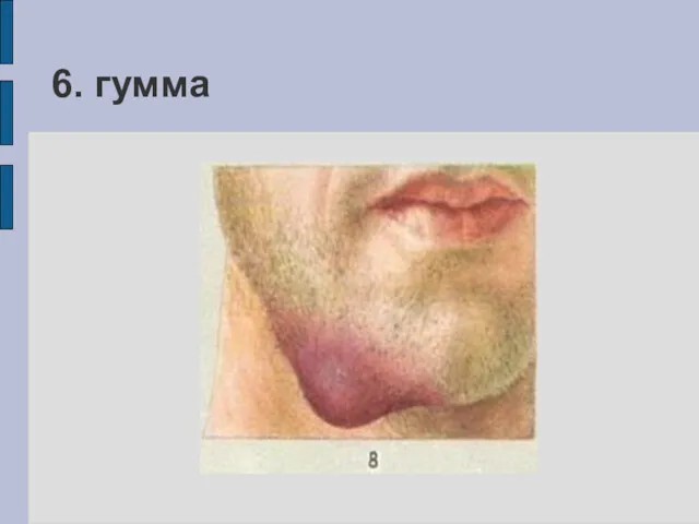 6. гумма