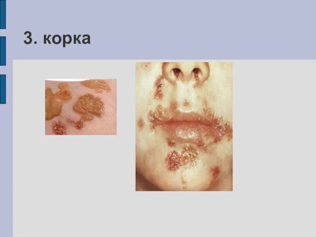 3. корка