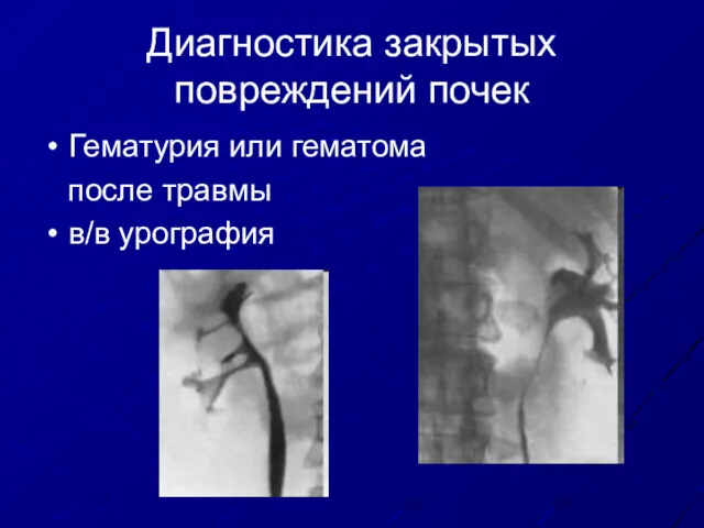 Диагностика закрытых повреждений почек Гематурия или гематома после травмы в/в урография