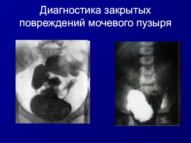 Диагностика закрытых повреждений мочевого пузыря