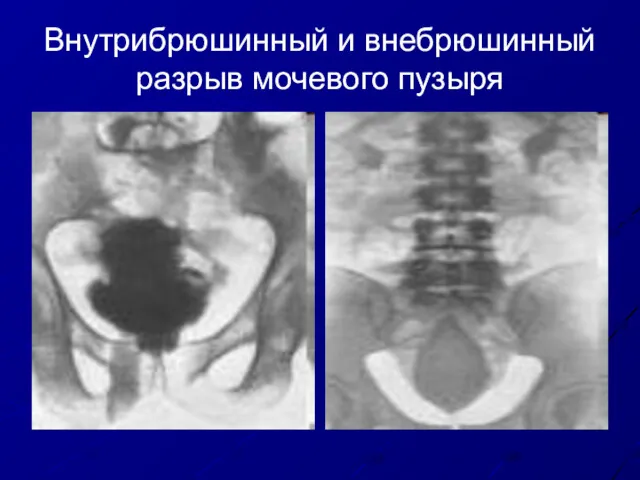 Внутрибрюшинный и внебрюшинный разрыв мочевого пузыря