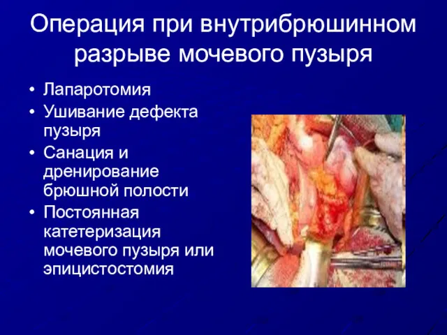 Операция при внутрибрюшинном разрыве мочевого пузыря Лапаротомия Ушивание дефекта пузыря Санация и дренирование