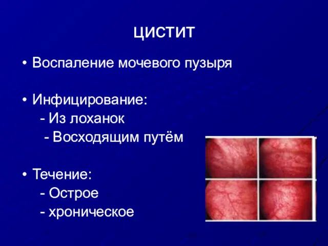 цистит Воспаление мочевого пузыря Инфицирование: - Из лоханок - Восходящим путём Течение: - Острое - хроническое