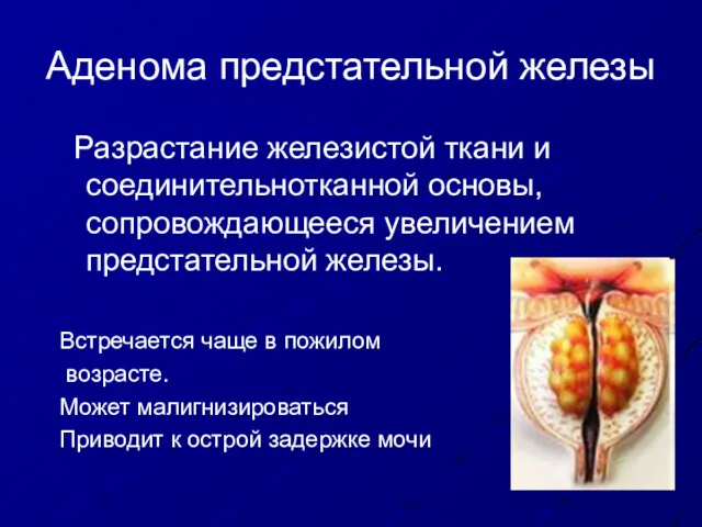 Аденома предстательной железы Разрастание железистой ткани и соединительнотканной основы, сопровождающееся увеличением предстательной железы.