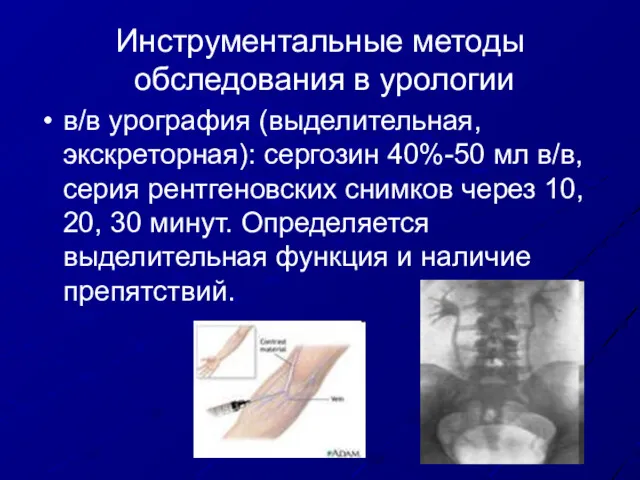 Инструментальные методы обследования в урологии в/в урография (выделительная, экскреторная): сергозин 40%-50 мл в/в,