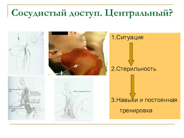 Сосудистый доступ. Центральный? 1.Ситуация 2.Стерильность 3.Навыки и постоянная тренировка