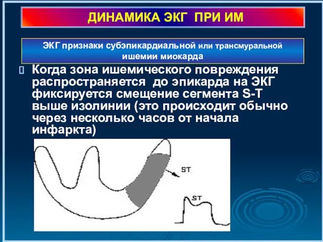 ДИНАМИКА ЭКГ ПРИ ИМ Когда зона ишемического повреждения распространяется до