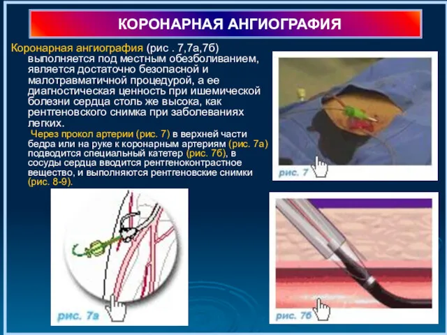 КОРОНАРНАЯ АНГИОГРАФИЯ Коронарная ангиография (рис . 7,7а,7б) выполняется под местным