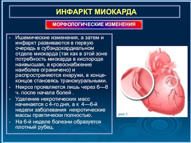 ИНФАРКТ МИОКАРДА Ишемические изменения, а затем и инфаркт развиваются в